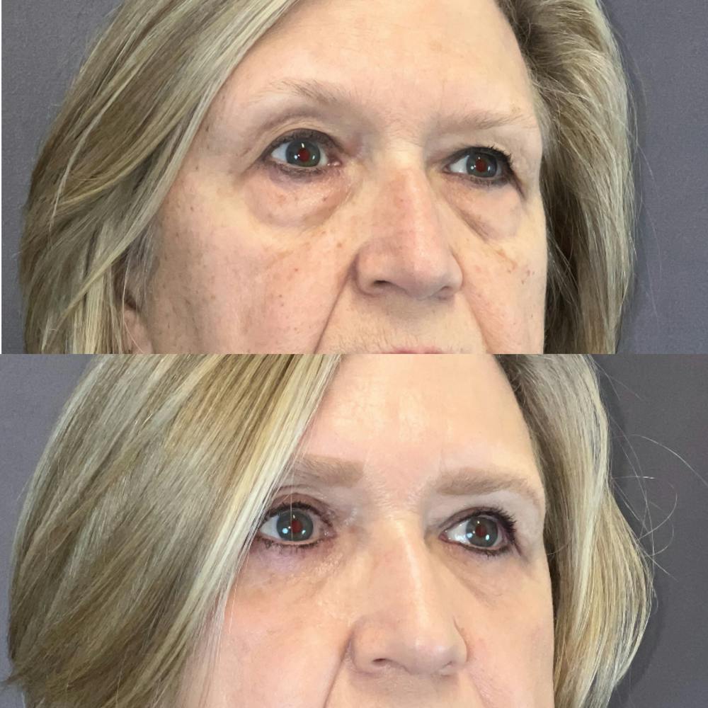 Lower Blepharoplasty Before & After Gallery - Patient 263707 - Image 3