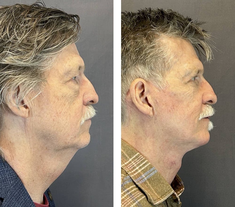 Facelift Before & After Gallery - Patient 661227 - Image 2