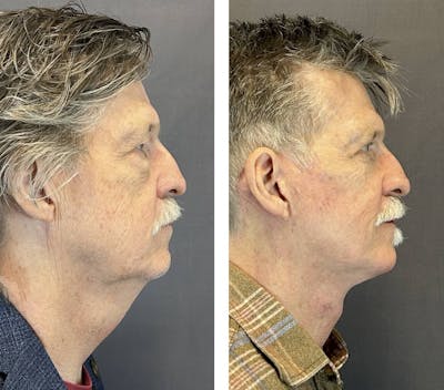 Facelift Before & After Gallery - Patient 661227 - Image 2