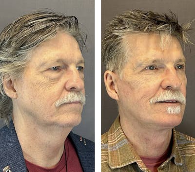 Upper Blepharoplasty Before & After Gallery - Patient 421233 - Image 2