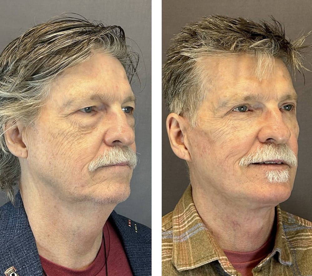 Upper Blepharoplasty Before & After Gallery - Patient 421233 - Image 2