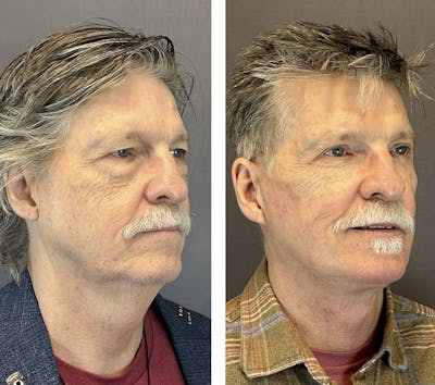 Lower Blepharoplasty Before & After Gallery - Patient 165141 - Image 2