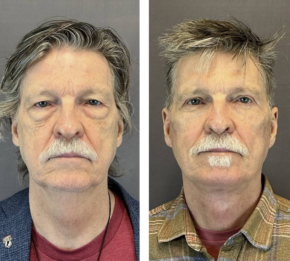 Upper Blepharoplasty Before & After Gallery - Patient 421233 - Image 1