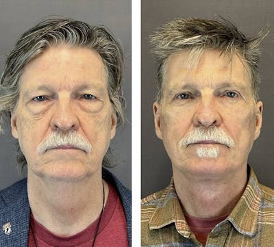 Necklift Before & After Gallery - Patient 397462 - Image 1