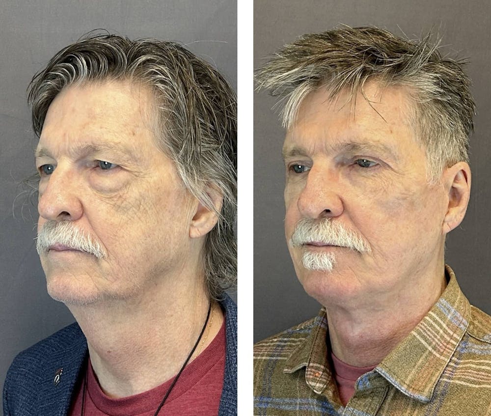 Necklift Before & After Gallery - Patient 397462 - Image 5