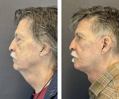 Necklift Before & After Gallery - Patient 397462 - Image 4