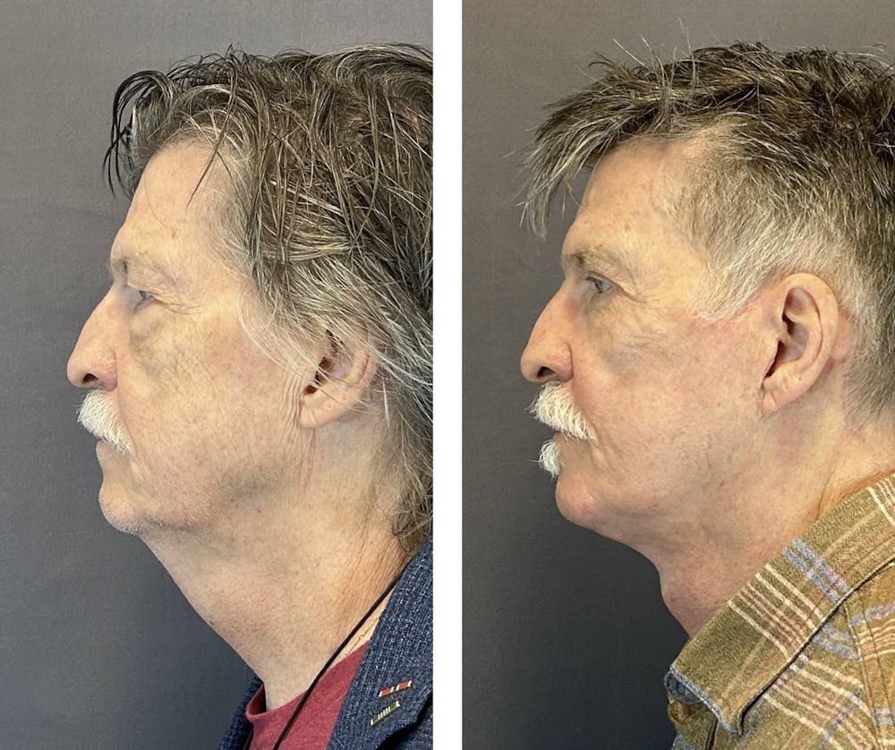 Facelift Before & After Gallery - Patient 661227 - Image 5