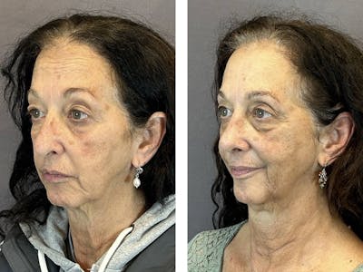 Rhinoplasty Before & After Gallery - Patient 219079 - Image 4