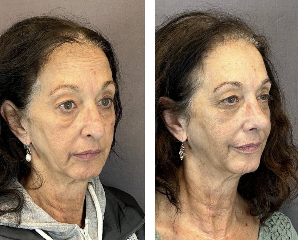 Rhinoplasty Before & After Gallery - Patient 219079 - Image 2