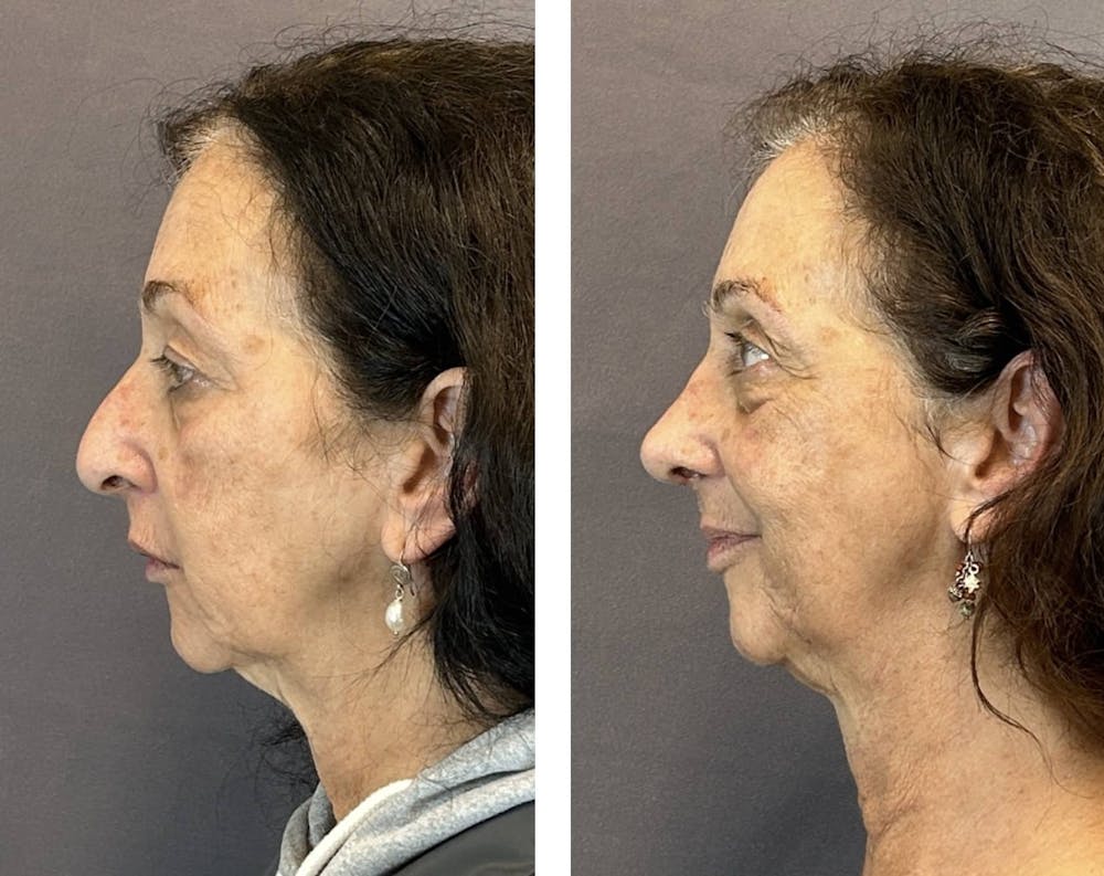 Rhinoplasty Before & After Gallery - Patient 219079 - Image 5