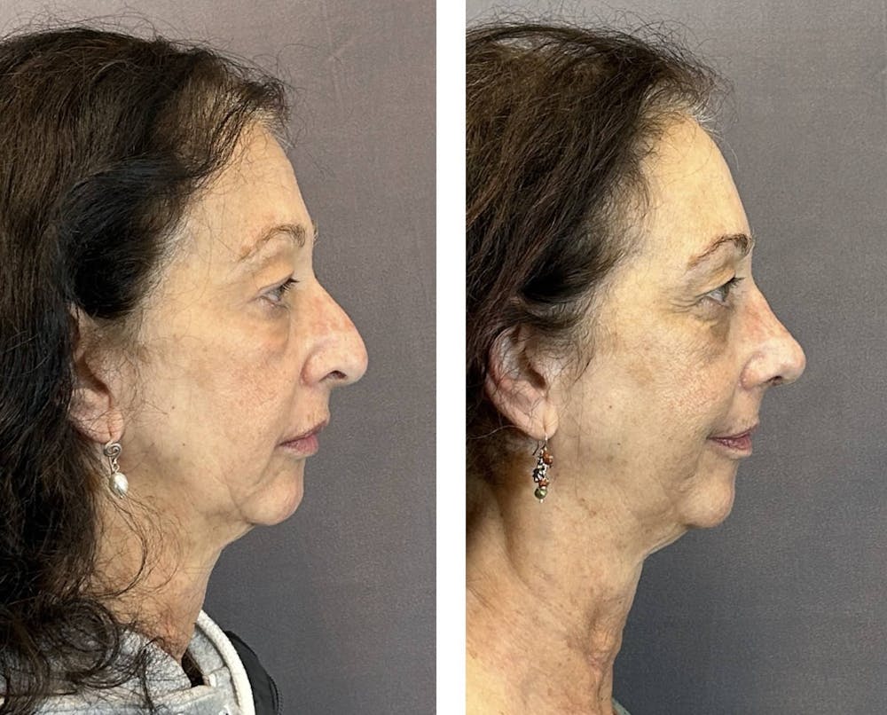 Rhinoplasty Before & After Gallery - Patient 219079 - Image 1