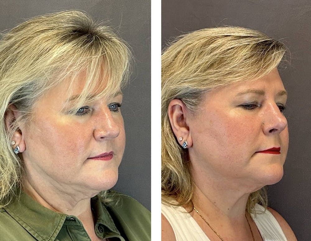 Rhinoplasty Before & After Gallery - Patient 318077 - Image 2