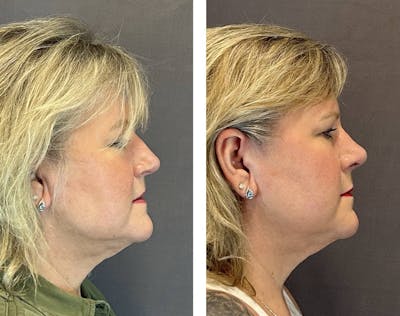 Rhinoplasty Before & After Gallery - Patient 318077 - Image 1