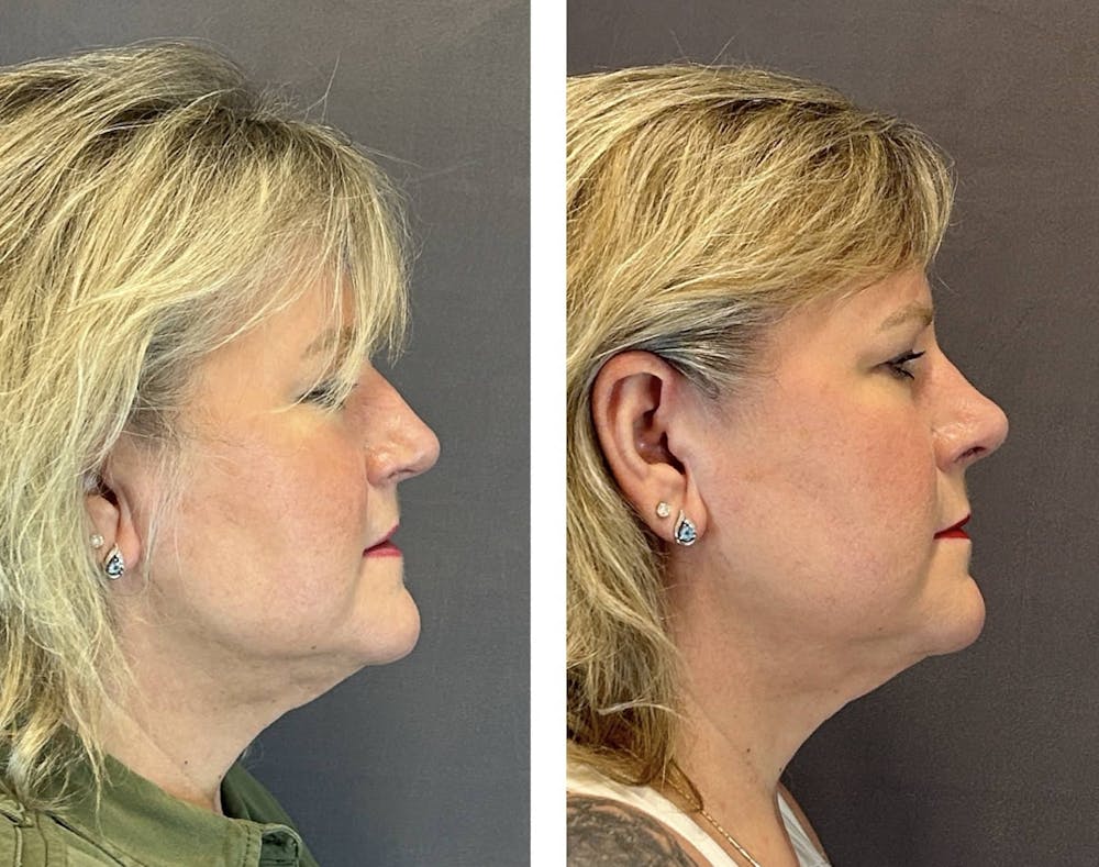 Rhinoplasty Before & After Gallery - Patient 318077 - Image 1