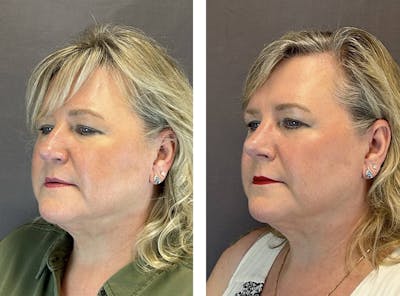 Rhinoplasty Before & After Gallery - Patient 318077 - Image 4