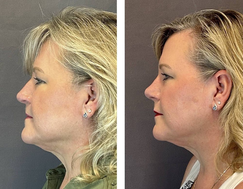 Rhinoplasty Before & After Gallery - Patient 318077 - Image 5