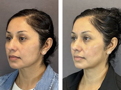 Rhinoplasty Before & After Gallery - Patient 124223 - Image 4