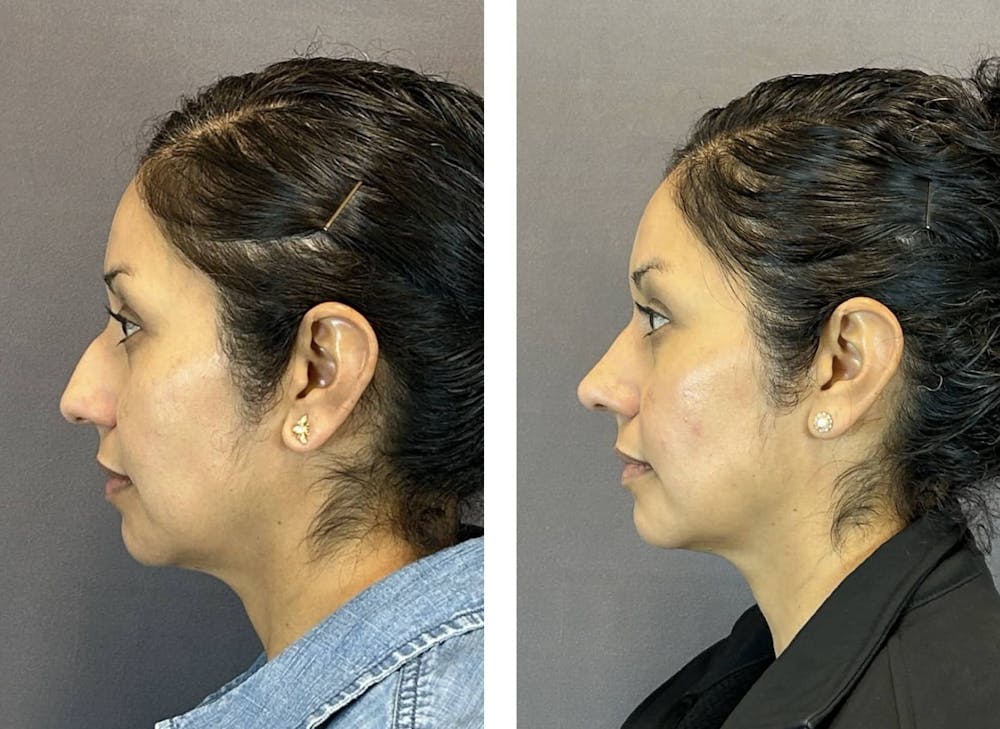 Rhinoplasty Before & After Gallery - Patient 124223 - Image 5