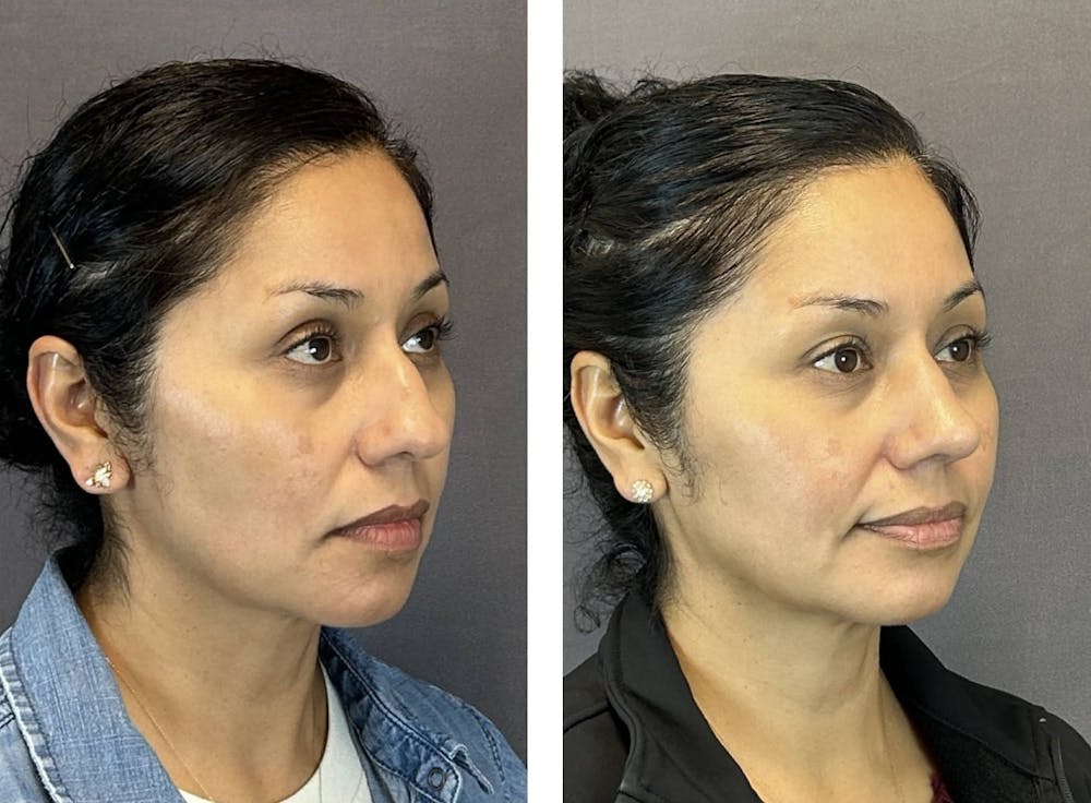 Rhinoplasty Before & After Gallery - Patient 124223 - Image 2