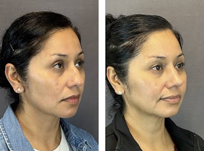Rhinoplasty Before & After Gallery - Patient 124223 - Image 2