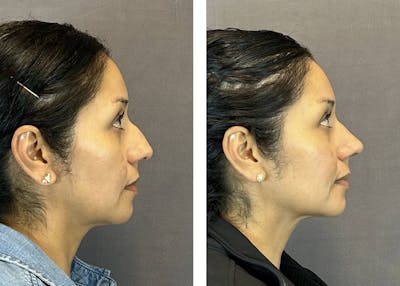Rhinoplasty Before & After Gallery - Patient 124223 - Image 1