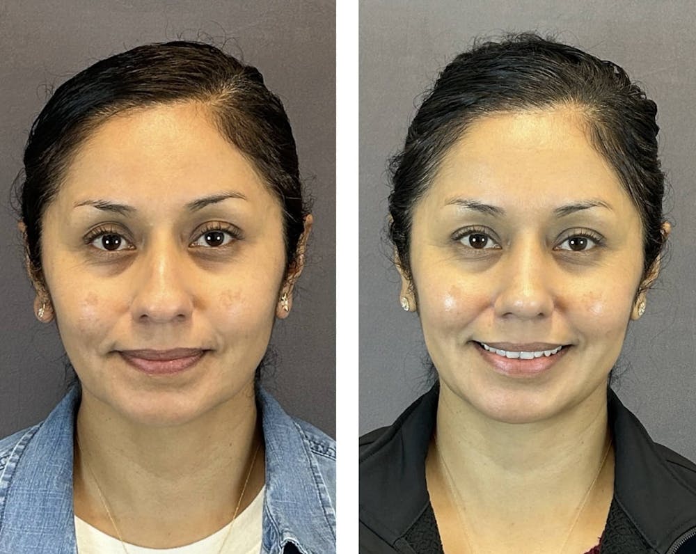 Rhinoplasty Before & After Gallery - Patient 124223 - Image 3