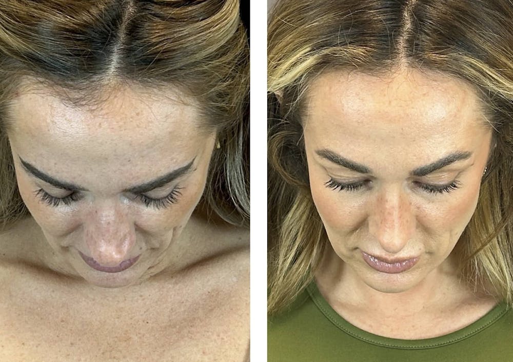 Rhinoplasty Before & After Gallery - Patient 384020 - Image 6