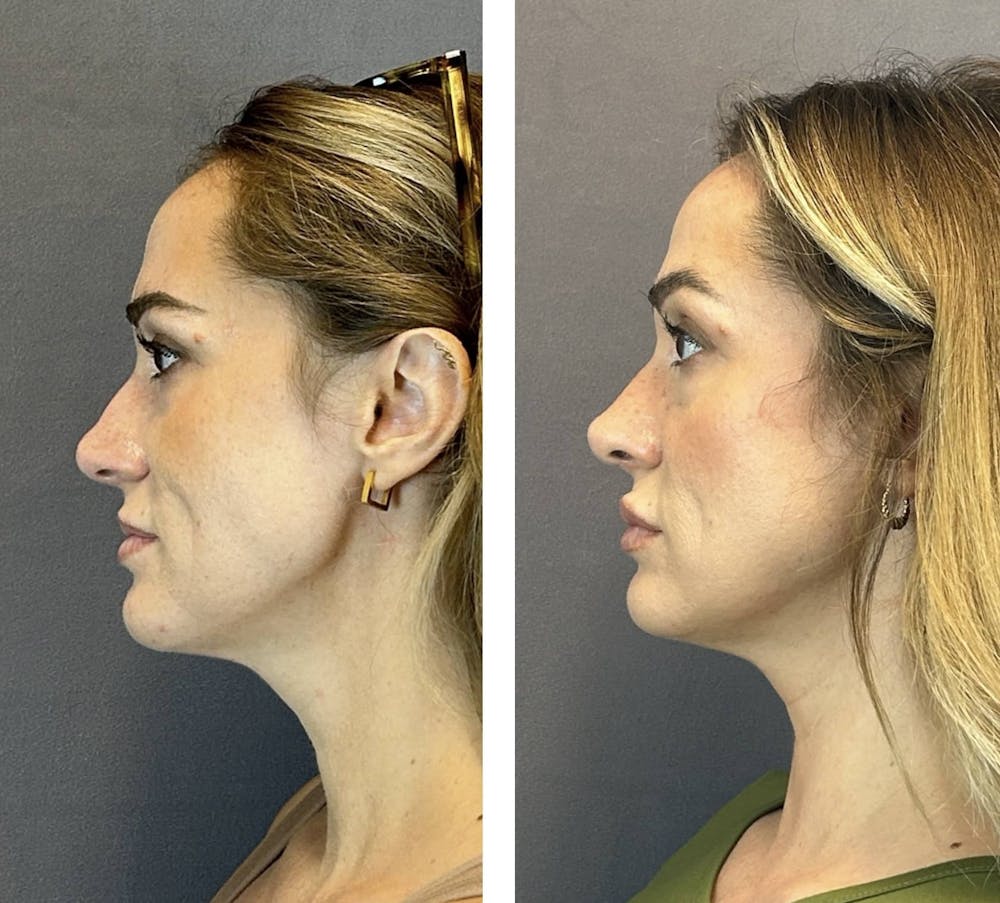 Rhinoplasty Before & After Gallery - Patient 384020 - Image 5