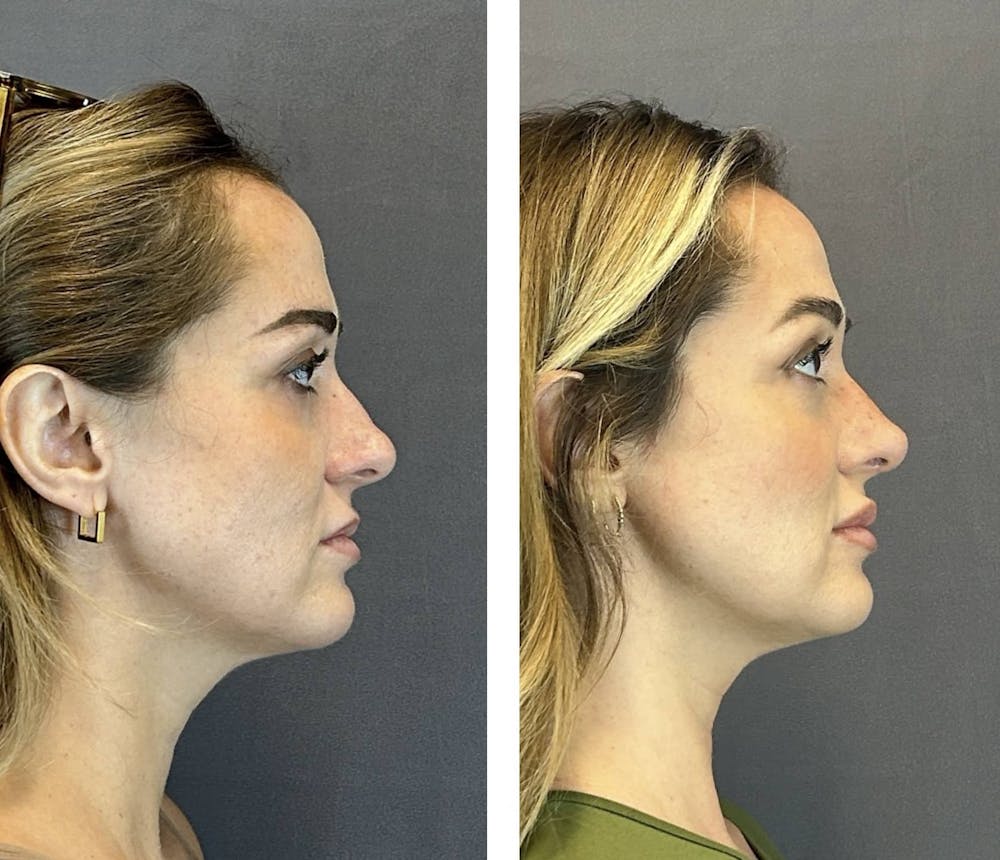 Rhinoplasty Before & After Gallery - Patient 384020 - Image 1