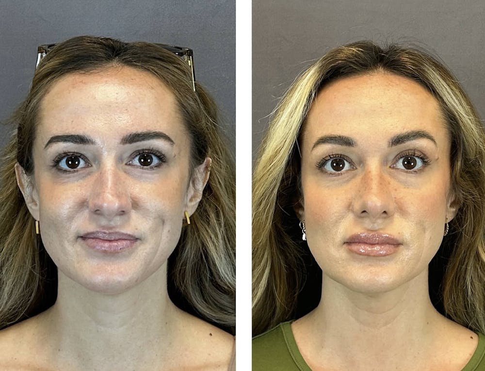 Rhinoplasty Before & After Gallery - Patient 384020 - Image 3