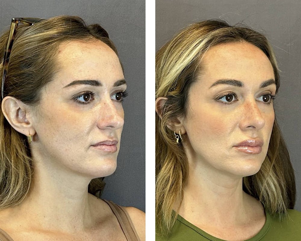Rhinoplasty Before & After Gallery - Patient 384020 - Image 2