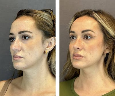 Rhinoplasty Before & After Gallery - Patient 384020 - Image 4
