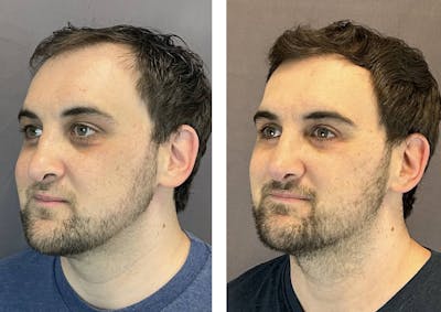 Rhinoplasty Before & After Gallery - Patient 374865 - Image 4