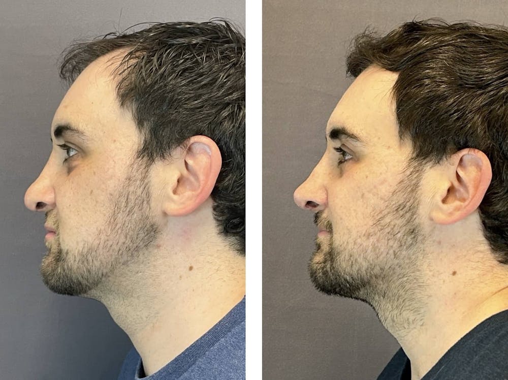 Rhinoplasty Before & After Gallery - Patient 374865 - Image 5
