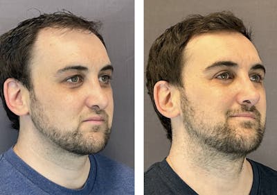 Rhinoplasty Before & After Gallery - Patient 374865 - Image 2