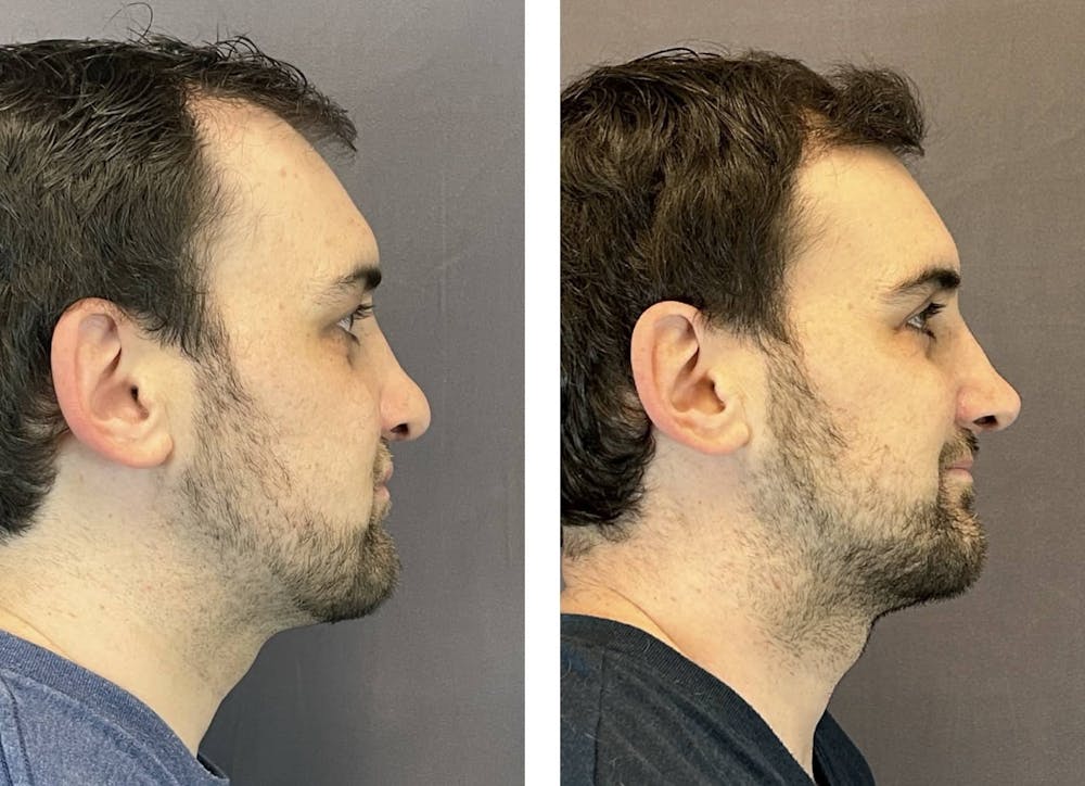 Rhinoplasty Before & After Gallery - Patient 374865 - Image 1