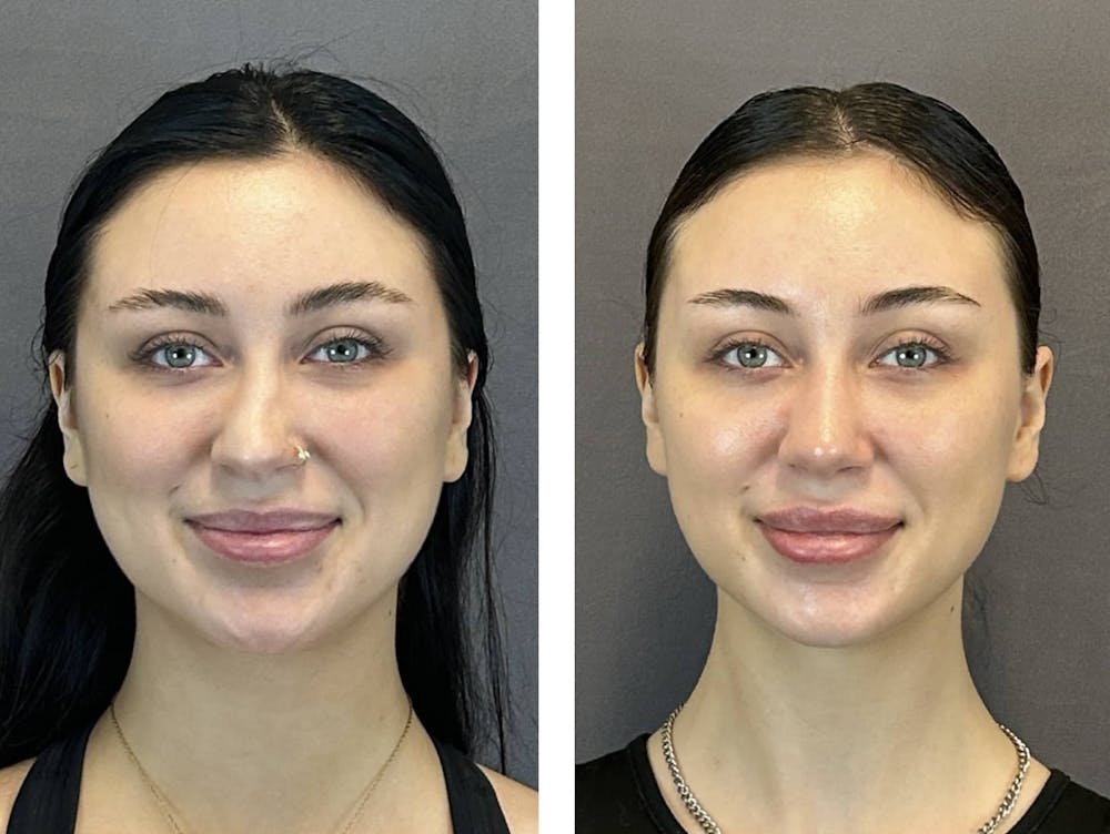 Rhinoplasty Before & After Gallery - Patient 359703 - Image 3