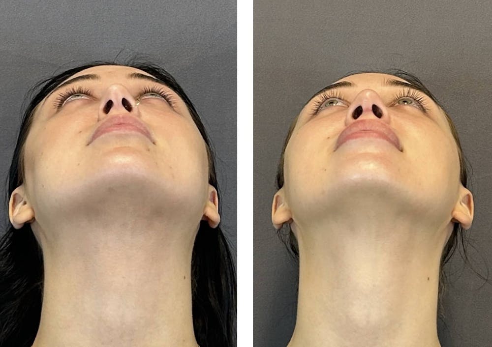 Rhinoplasty Before & After Gallery - Patient 359703 - Image 5