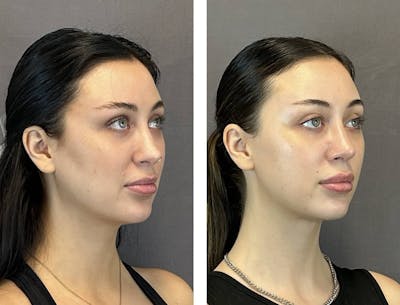 Rhinoplasty Before & After Gallery - Patient 359703 - Image 2