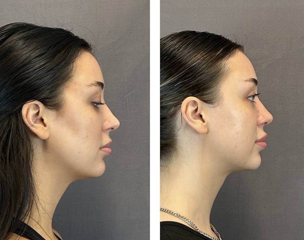 Rhinoplasty Before & After Gallery - Patient 359703 - Image 1