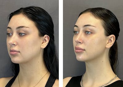 Rhinoplasty Before & After Gallery - Patient 359703 - Image 6