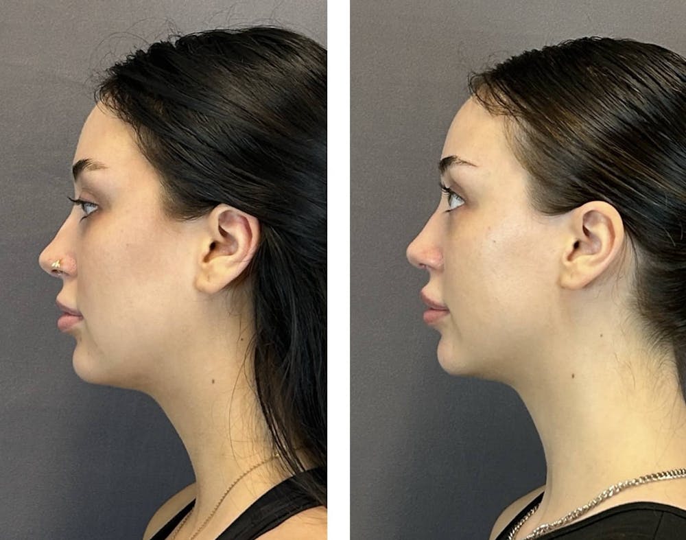 Rhinoplasty Before & After Gallery - Patient 359703 - Image 7
