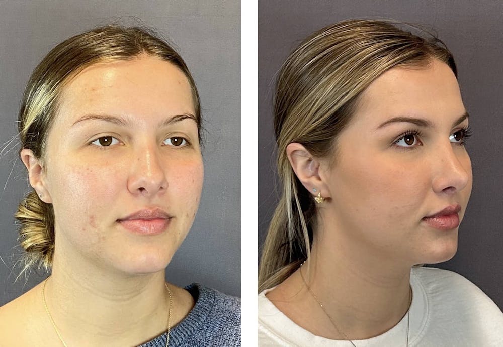 Rhinoplasty Before & After Gallery - Patient 205207 - Image 2