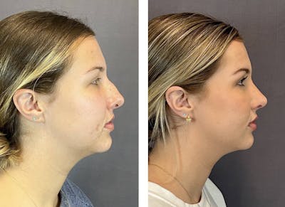 Rhinoplasty Before & After Gallery - Patient 205207 - Image 1