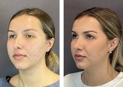 Rhinoplasty Before & After Gallery - Patient 205207 - Image 4