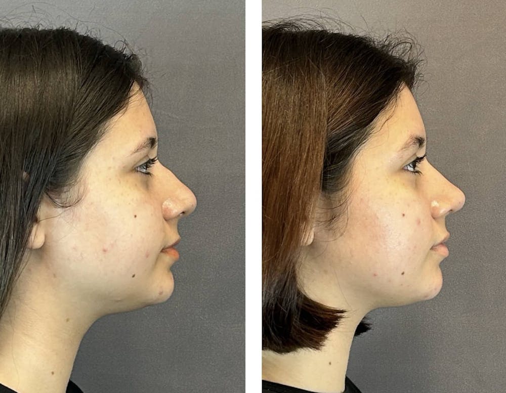 Rhinoplasty Before & After Gallery - Patient 394474 - Image 1