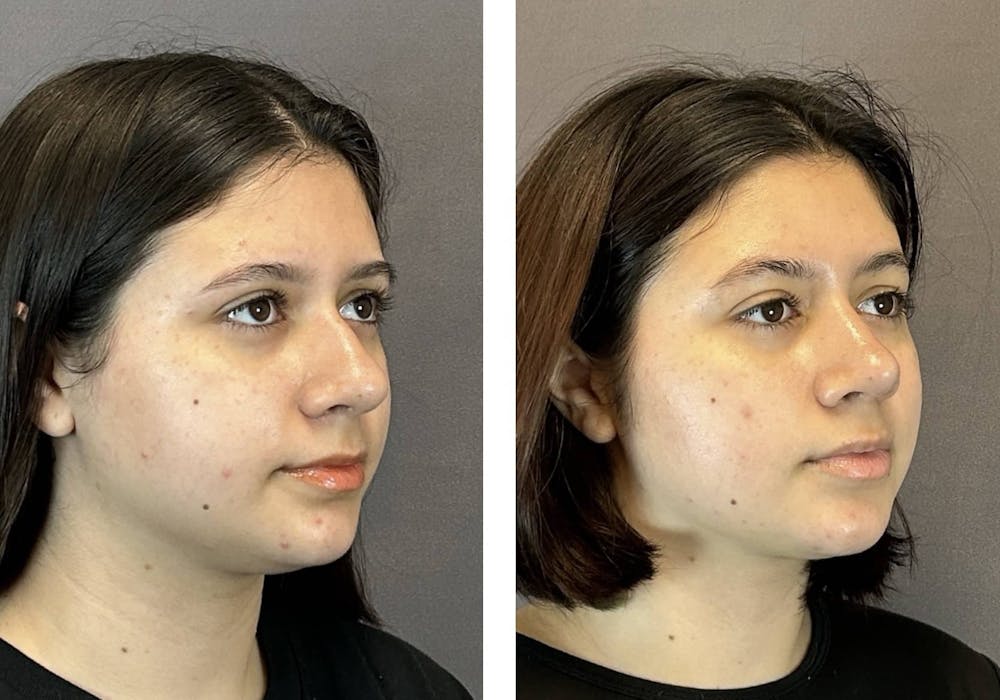 Rhinoplasty Before & After Gallery - Patient 394474 - Image 2