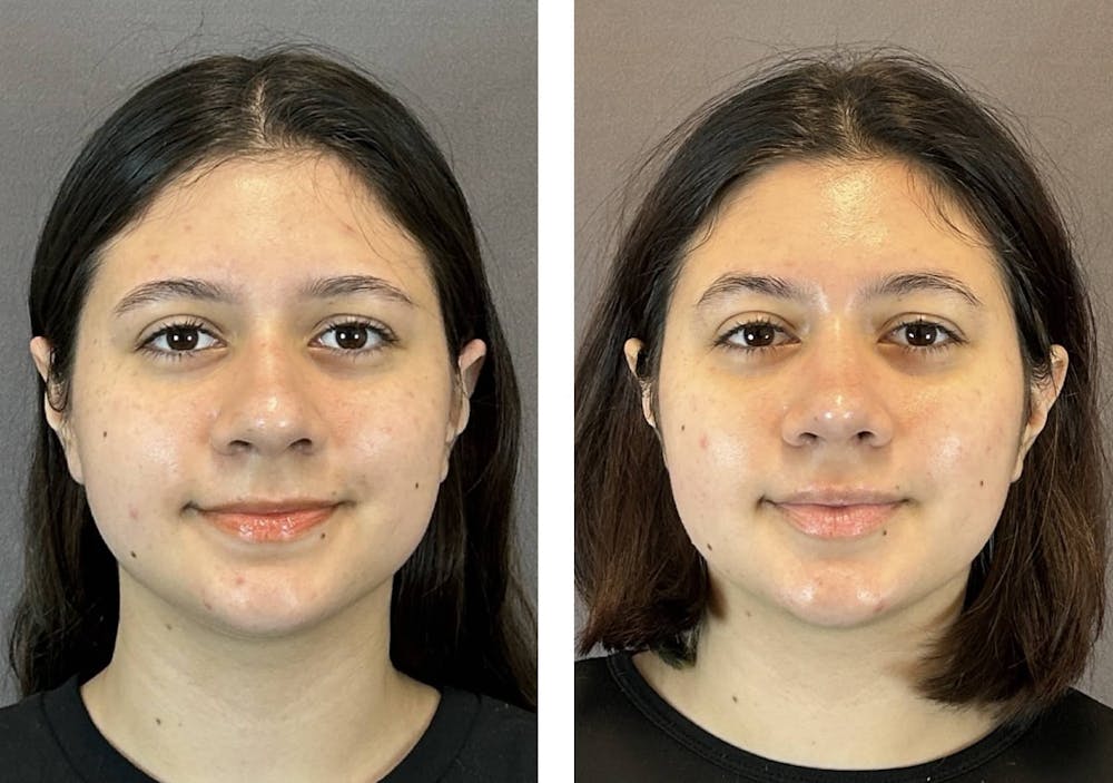 Rhinoplasty Before & After Gallery - Patient 394474 - Image 3