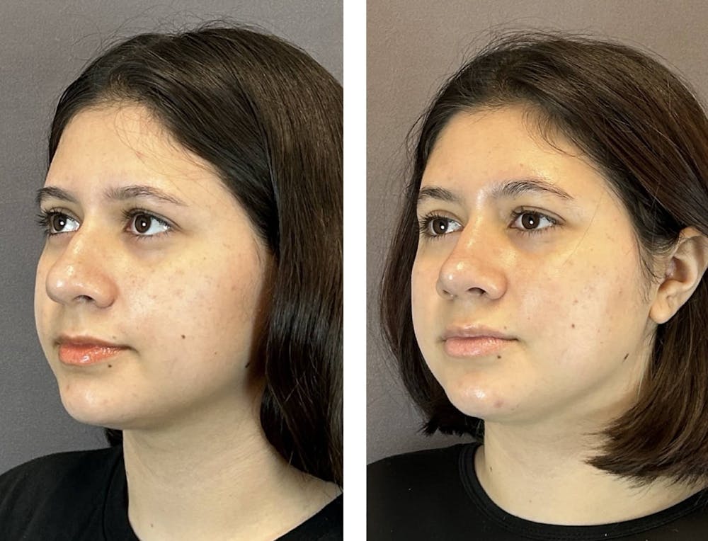 Rhinoplasty Before & After Gallery - Patient 394474 - Image 4