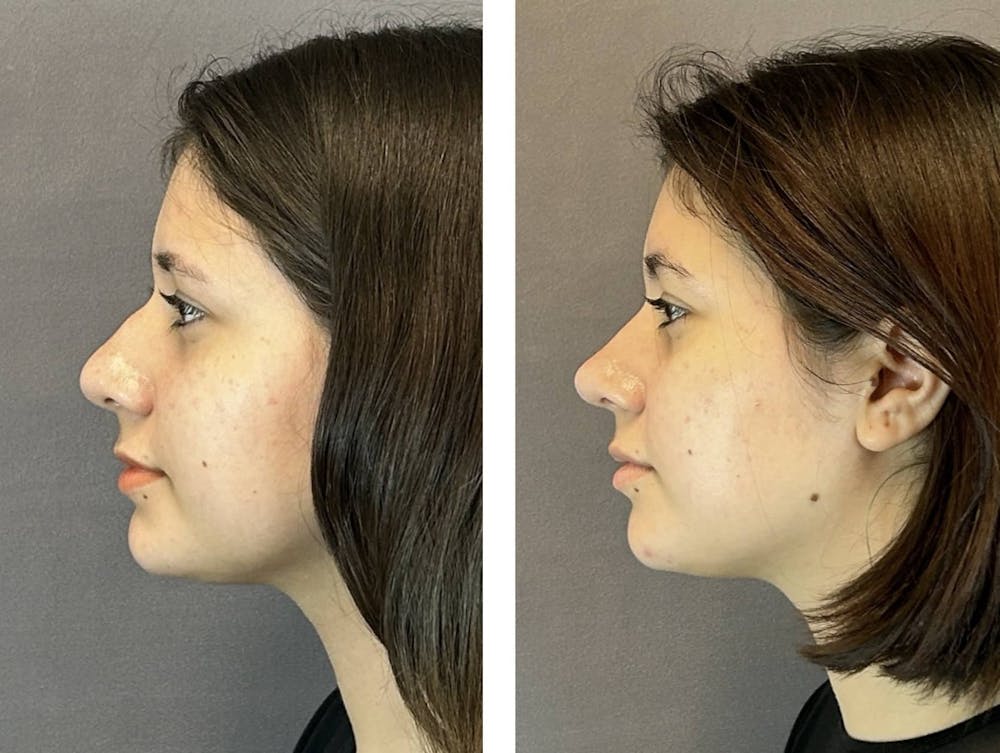 Rhinoplasty Before & After Gallery - Patient 394474 - Image 5